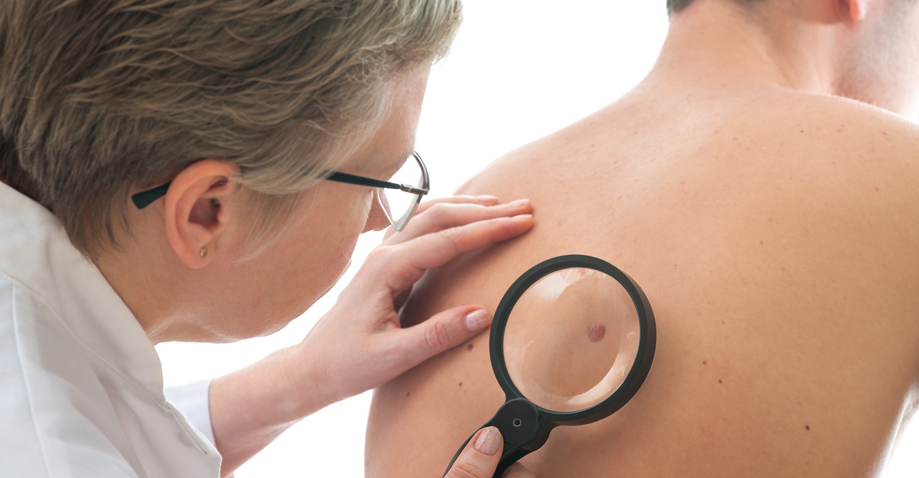 Le dépistage du cancer de la peau passe par le suivi des grains de beauté. © Alexander Raths, Shutterstock