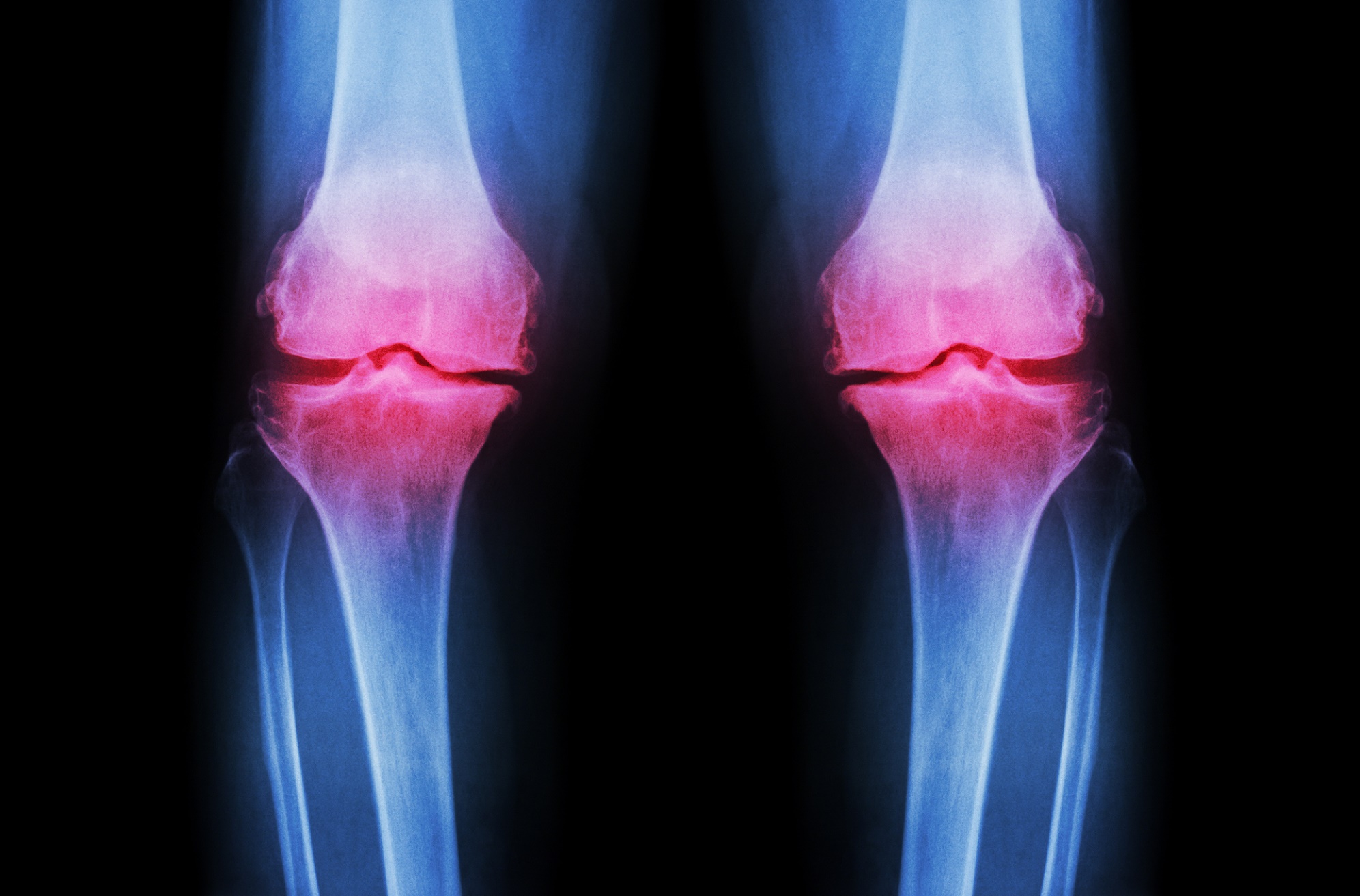L’arthrose est une maladie douloureuse dans laquelle le cartilage est détruit. Et si l’impression 3D pouvait le régénérer ? © Puwadol Jaturawutthichai, Shutterstock