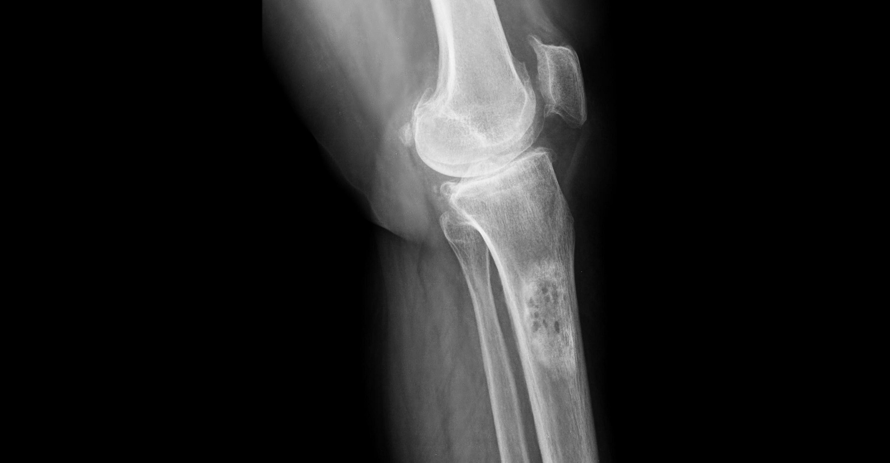 Le cancer de l'os peut être détecté par radiographie. © wonderisland, Shutterstock