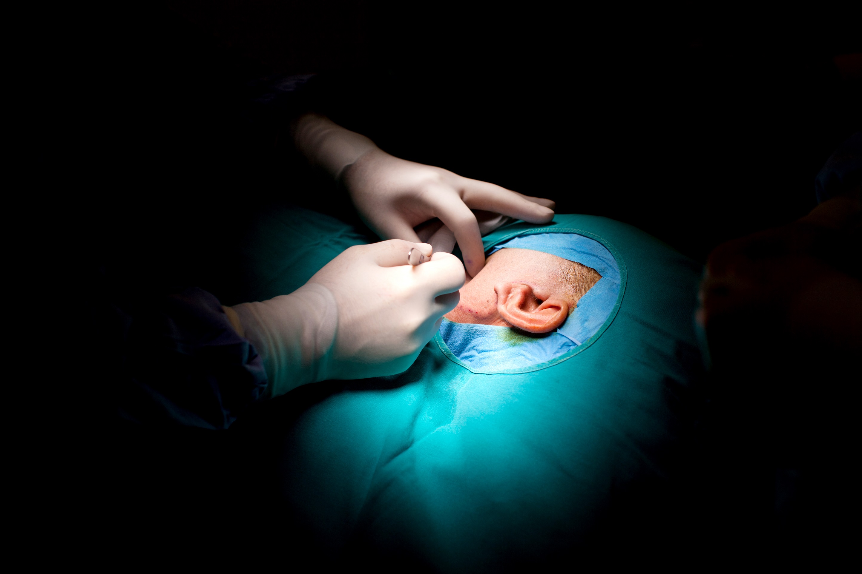 Un implant expérimental de tissu vivant bio-imprimé en 3D a été greffé sur une patiente atteinte&nbsp;de microtie, une maladie congénitale qui se caractérise par une oreille externe incomplète. © Ciseren, Getty Images
