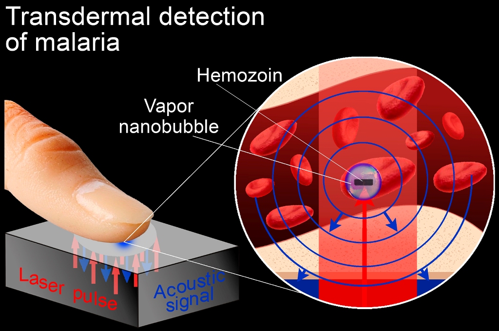 Avec la technique mise au point par des chercheurs de l'université Rice, un porteur de parasites à l'origine de la malaria peut être diagnostiqué en quelques secondes. Comme le montre le schéma, il lui suffit de poser son index sur un petit dispositif générant des impulsions laser (laser pulses). Celles-ci vont provoquer l'apparition de nanobulles de vapeur (vapor nanobubbles) caractéristiques dans les globules rouges infectés. Les ondes sonores (acoustic signal) produites par l'éclatement de ces bulles sont des traces nettes et facilement détectables de la présence de ces nanobulles. © E. Lukianova-Hleb, université Rice