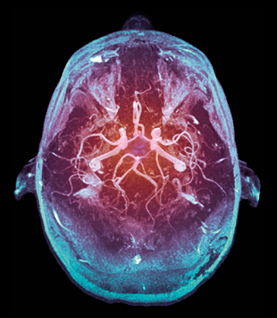 Le cercle artériel du cerveau, ou polygone de Willis, est un réseau d'artères présent dans le cerveau. Il assure l'approvisionnement en nutriments et en oxygène aux neurones. © Victor Brezinsky, Flickr, cc by sa 2.0