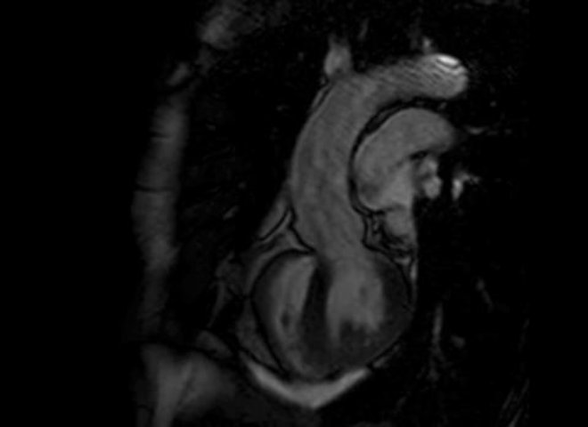 Un battement du cœur filmé par IRM